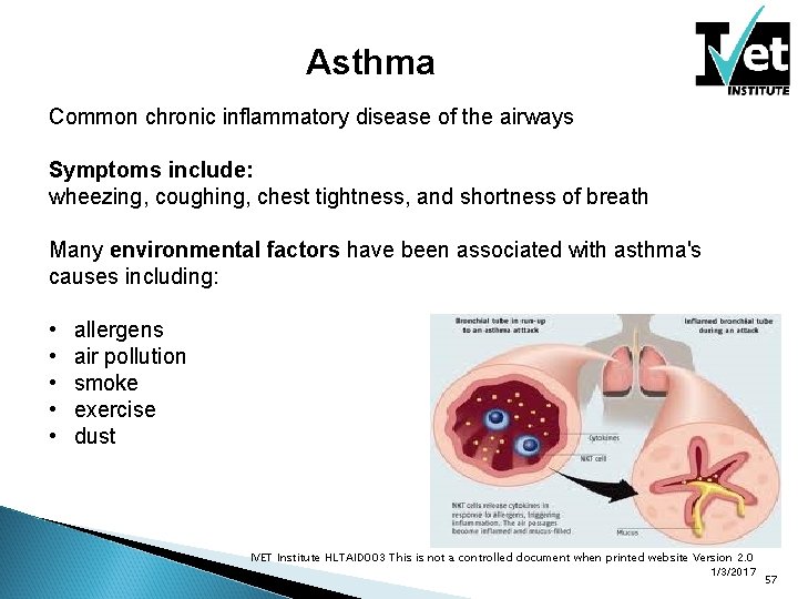Asthma Common chronic inflammatory disease of the airways Symptoms include: wheezing, coughing, chest tightness,