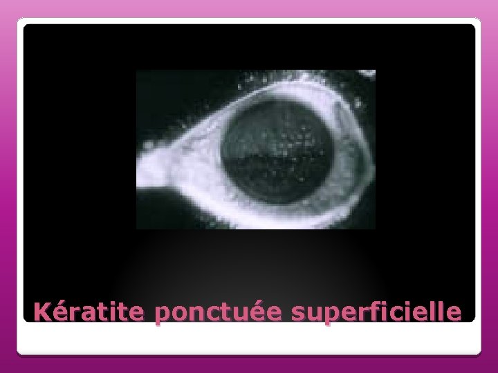 Kératite ponctuée superficielle Kératite ponctuée superficielle