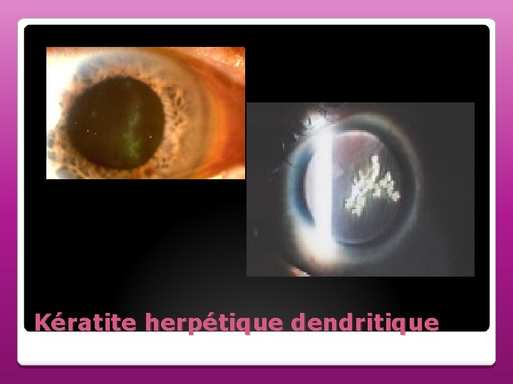 Kératite herpétique dendritique 