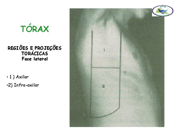 TÓRAX REGIÕES E PROJEÇÕES TORÁCICAS Face lateral • 1 ) Axilar • 2) Infra-axilar