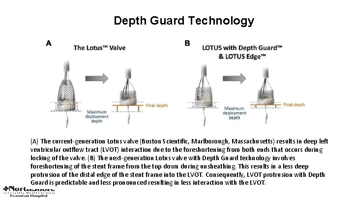 Depth Guard Technology (A) The current-generation Lotus valve (Boston Scientific, Marlborough, Massachusetts) results in Depth Guard Technology (A) The current-generation Lotus valve (Boston Scientific, Marlborough, Massachusetts) results in