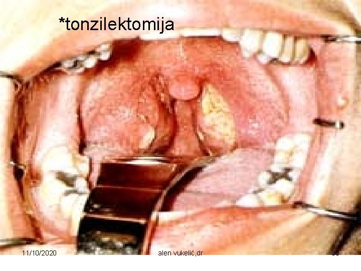 *tonzilektomija 11/10/2020 alen vukelić, dr 33 