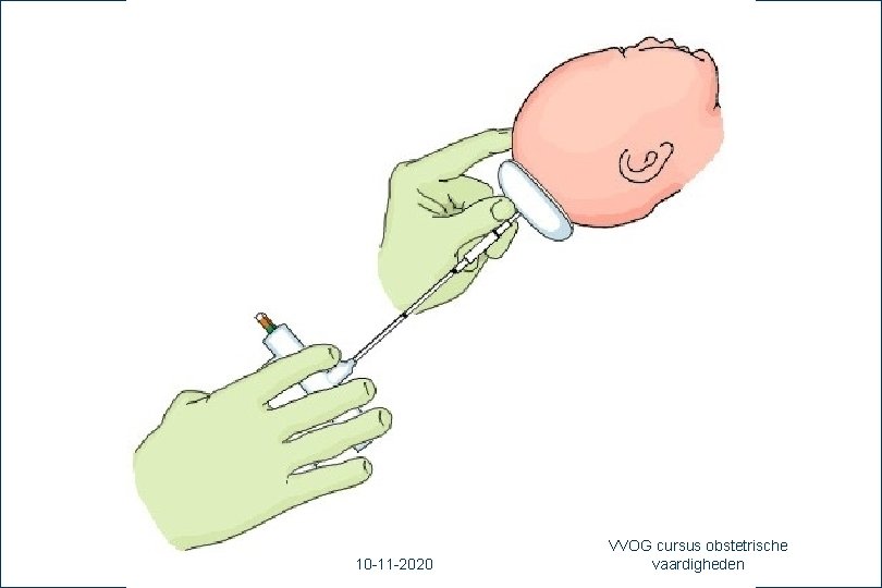 39 10 -11 -2020 VVOG cursus obstetrische vaardigheden 