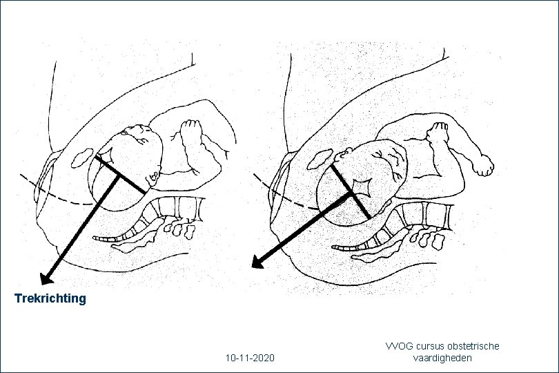 Trekrichting 40 10 -11 -2020 VVOG cursus obstetrische vaardigheden 