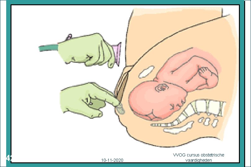 42 10 -11 -2020 VVOG cursus obstetrische vaardigheden 