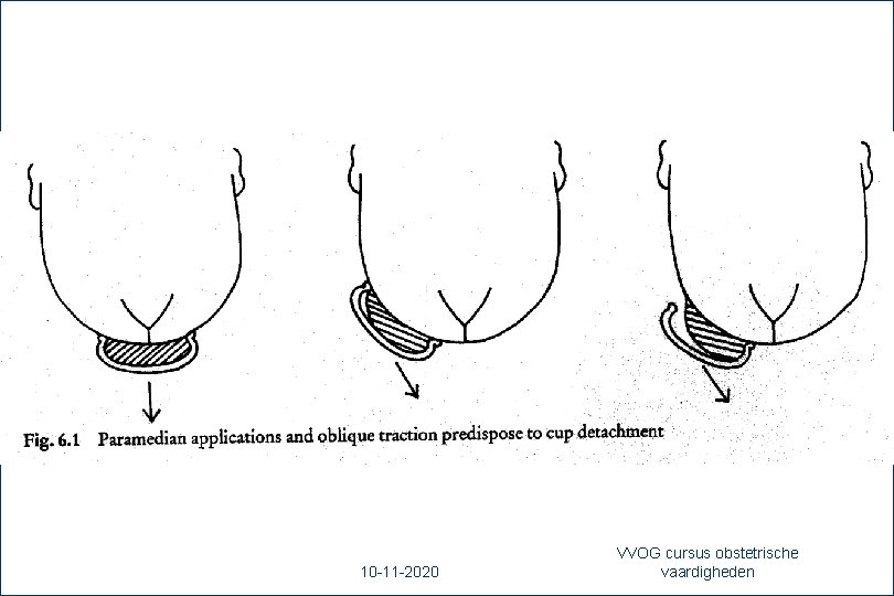 50 10 -11 -2020 VVOG cursus obstetrische vaardigheden 