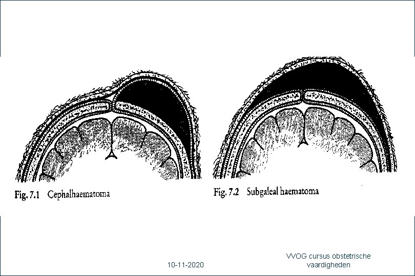 55 10 -11 -2020 VVOG cursus obstetrische vaardigheden 
