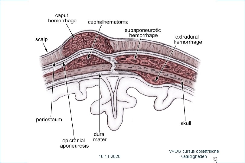 56 10 -11 -2020 VVOG cursus obstetrische vaardigheden 