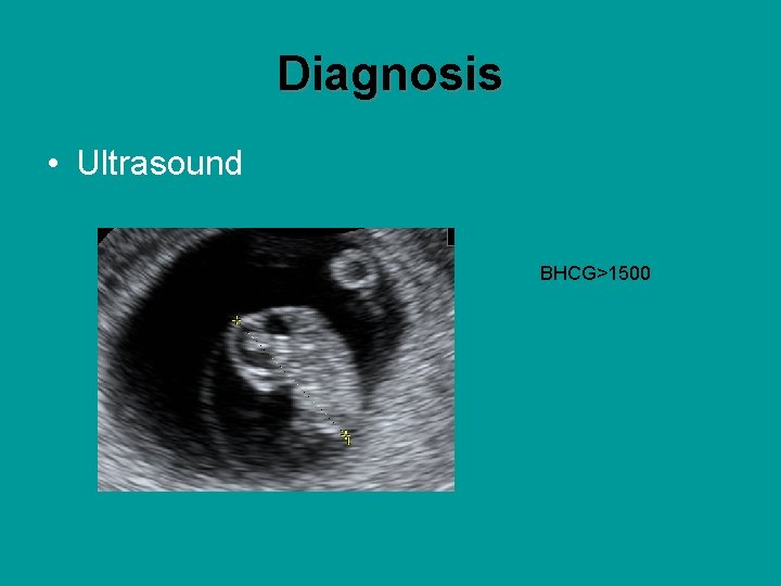 Diagnosis • Ultrasound BHCG>1500 