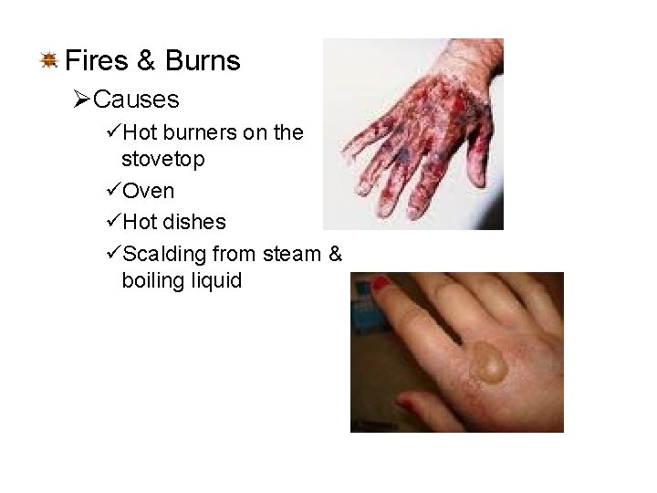 Fires & Burns ØCauses üHot burners on the stovetop üOven üHot dishes üScalding from Fires & Burns ØCauses üHot burners on the stovetop üOven üHot dishes üScalding from