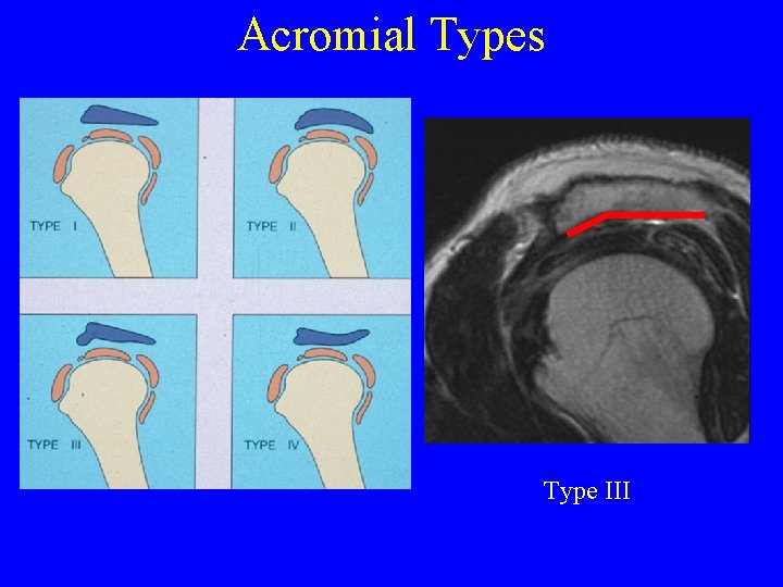 Acromial Types Type III 