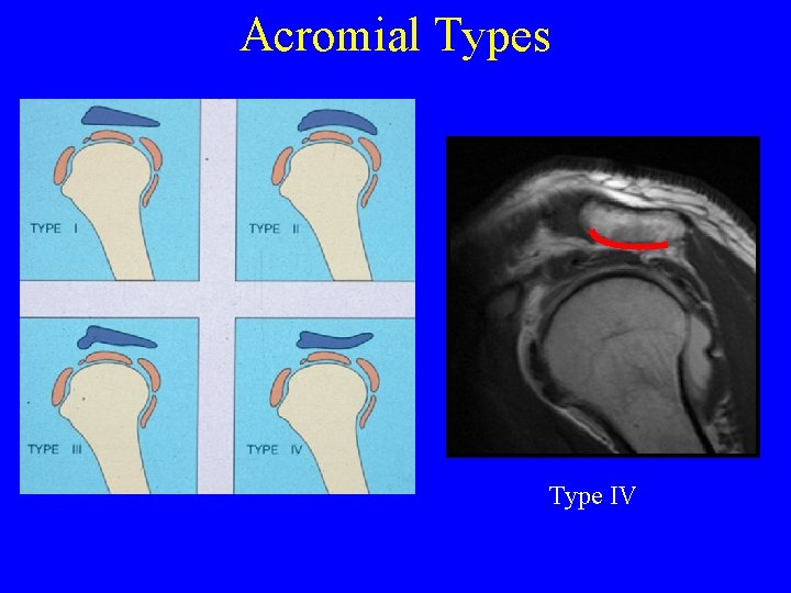 Acromial Types Type IV 