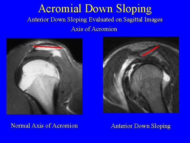 Acromial Down Sloping Anterior Down Sloping Evaluated on Sagittal Images Axis of Acromion Normal