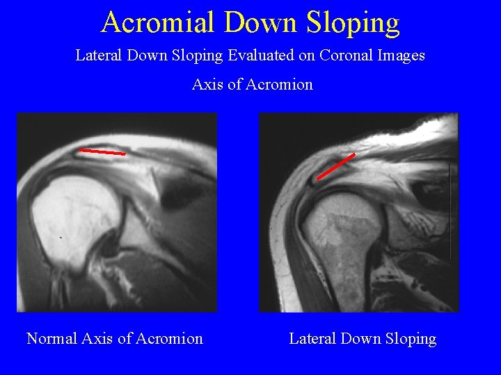 Acromial Down Sloping Lateral Down Sloping Evaluated on Coronal Images Axis of Acromion Normal