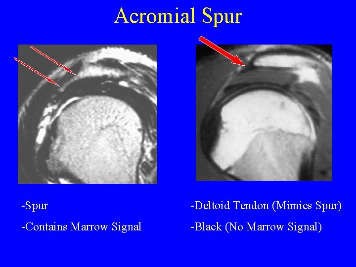 Acromial Spur -Deltoid Tendon (Mimics Spur) -Contains Marrow Signal -Black (No Marrow Signal) 