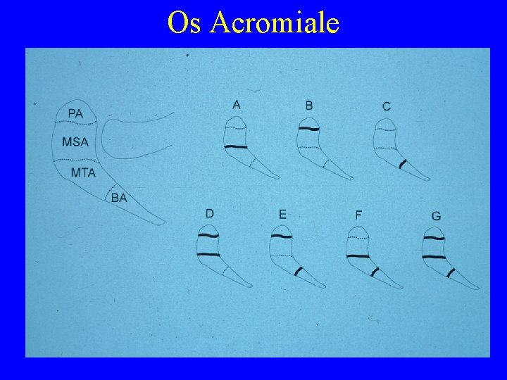Os Acromiale 