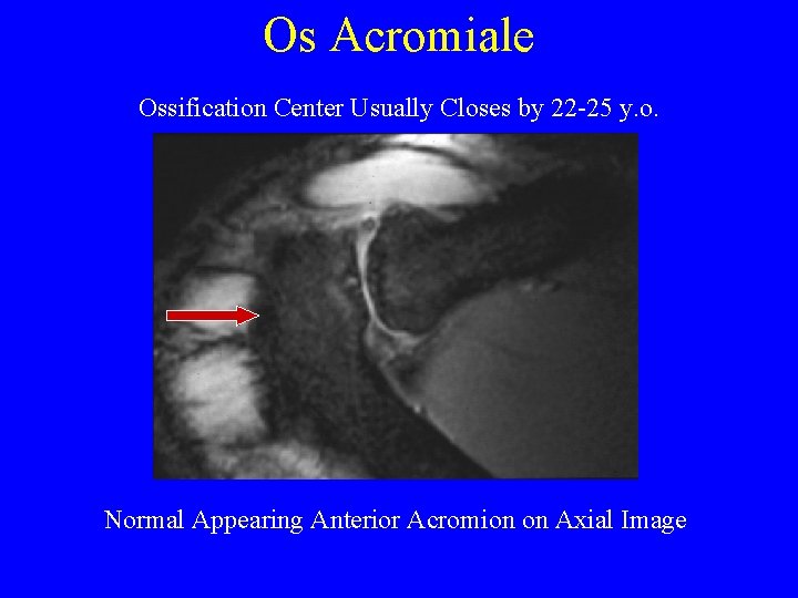 Os Acromiale Ossification Center Usually Closes by 22 -25 y. o. Normal Appearing Anterior