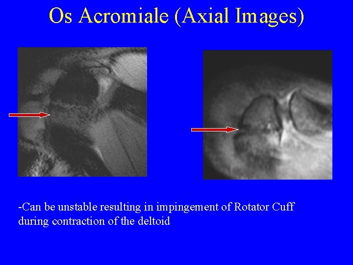 Os Acromiale (Axial Images) -Can be unstable resulting in impingement of Rotator Cuff during