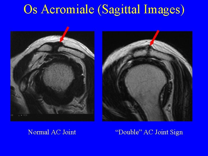 Os Acromiale (Sagittal Images) Normal AC Joint “Double” AC Joint Sign 