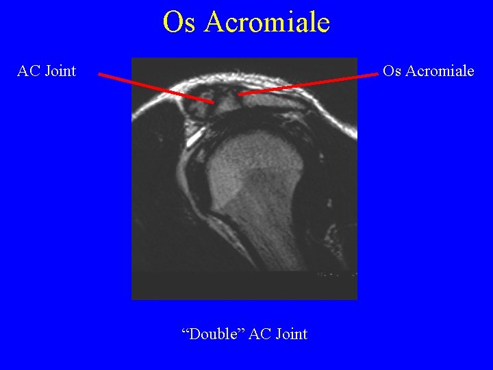 Os Acromiale AC Joint Os Acromiale “Double” AC Joint 