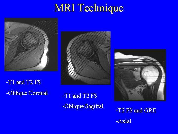 MRI Technique -T 1 and T 2 FS -Oblique Coronal -T 1 and T
