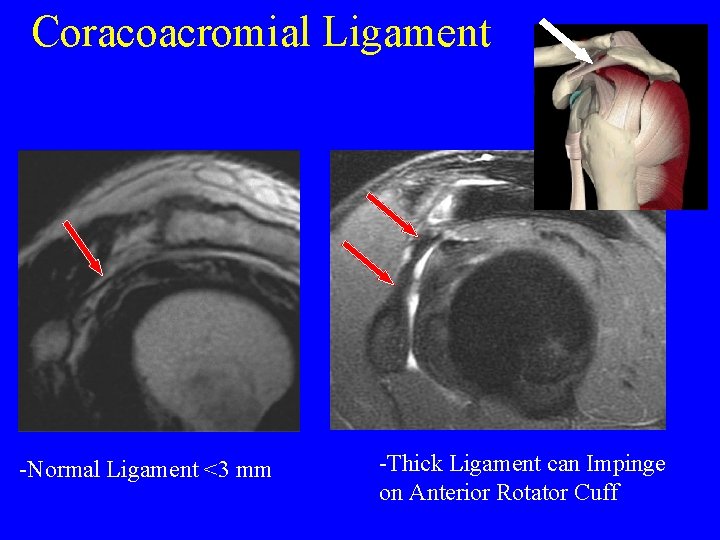 Coracoacromial Ligament -Normal Ligament <3 mm -Thick Ligament can Impinge on Anterior Rotator Cuff