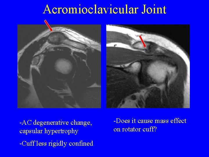 Acromioclavicular Joint -AC degenerative change, capsular hypertrophy -Cuff less rigidly confined -Does it cause