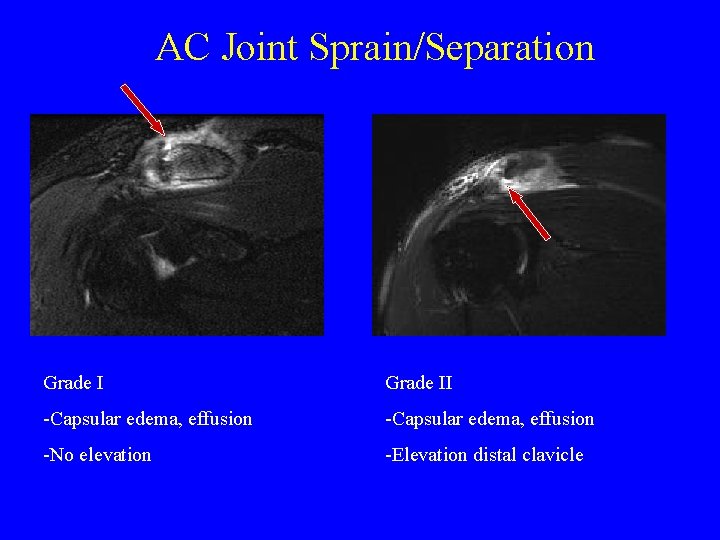 AC Joint Sprain/Separation Grade II -Capsular edema, effusion -No elevation -Elevation distal clavicle 