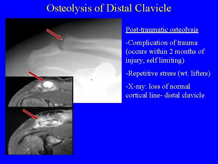 Osteolysis of Distal Clavicle Post-traumatic osteolysis -Complication of trauma (occurs within 2 months of