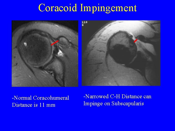 Coracoid Impingement -Normal Coracohumeral Distance is 11 mm -Narrowed C-H Distance can Impinge on