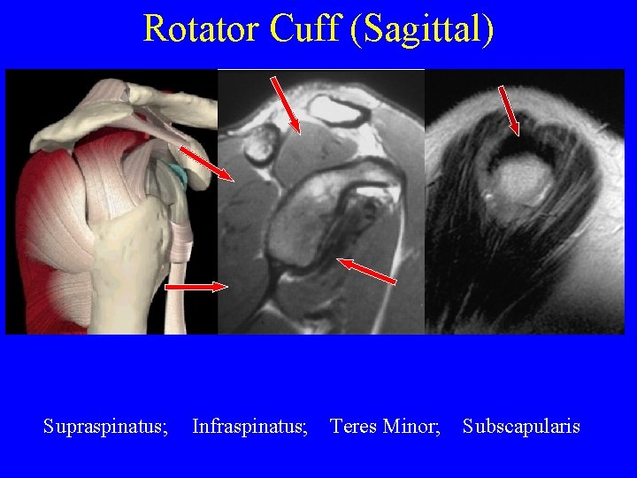 Rotator Cuff (Sagittal) Supraspinatus; Infraspinatus; Teres Minor; Subscapularis 