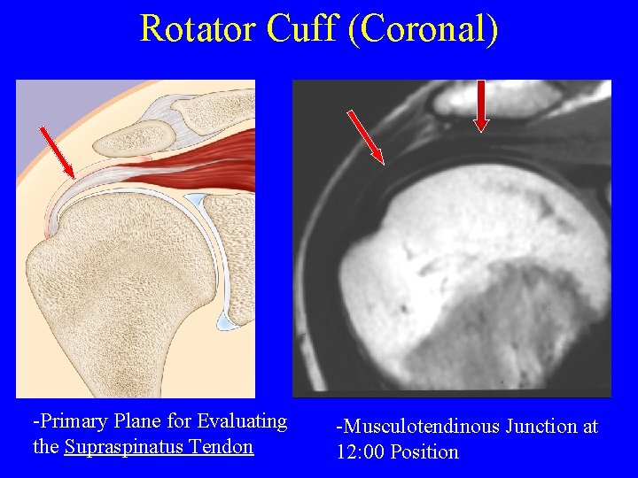 Rotator Cuff (Coronal) -Primary Plane for Evaluating the Supraspinatus Tendon -Musculotendinous Junction at 12:
