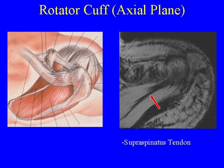 Rotator Cuff (Axial Plane) -Supraspinatus Tendon 