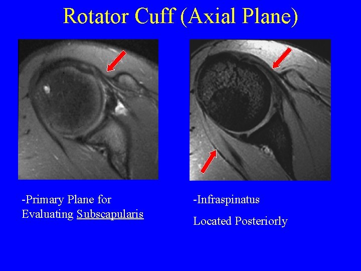Rotator Cuff (Axial Plane) -Primary Plane for Evaluating Subscapularis -Infraspinatus Located Posteriorly 