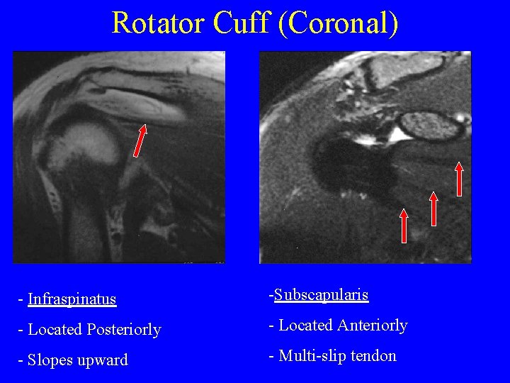 Rotator Cuff (Coronal) - Infraspinatus -Subscapularis - Located Posteriorly - Located Anteriorly - Slopes