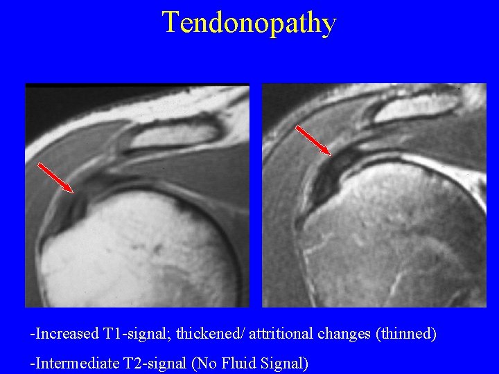 Tendonopathy -Increased T 1 -signal; thickened/ attritional changes (thinned) -Intermediate T 2 -signal (No