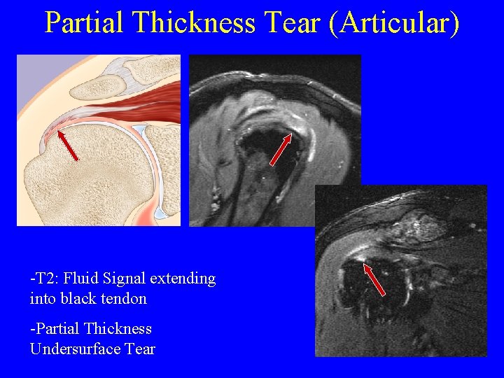 Partial Thickness Tear (Articular) -T 2: Fluid Signal extending into black tendon -Partial Thickness