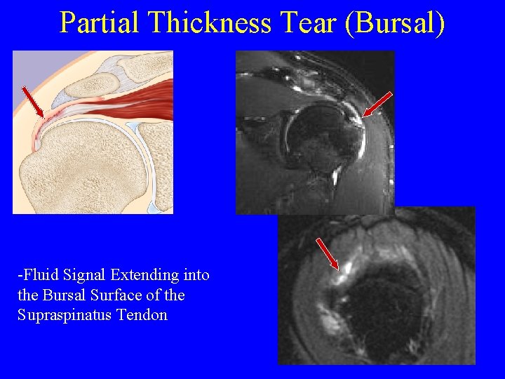 Partial Thickness Tear (Bursal) -Fluid Signal Extending into the Bursal Surface of the Supraspinatus