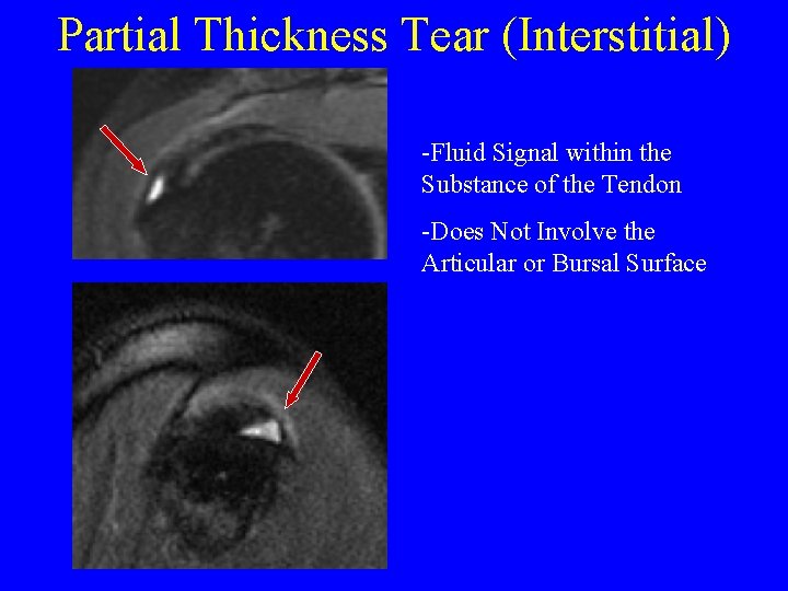 Partial Thickness Tear (Interstitial) -Fluid Signal within the Substance of the Tendon -Does Not