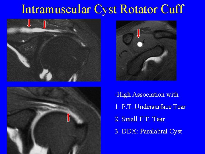 Intramuscular Cyst Rotator Cuff -High Association with 1. P. T. Undersurface Tear 2. Small