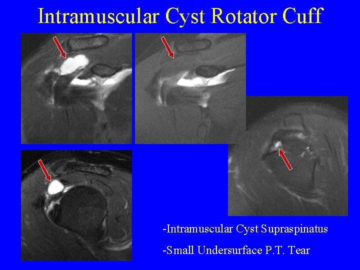 Intramuscular Cyst Rotator Cuff -Intramuscular Cyst Supraspinatus -Small Undersurface P. T. Tear 