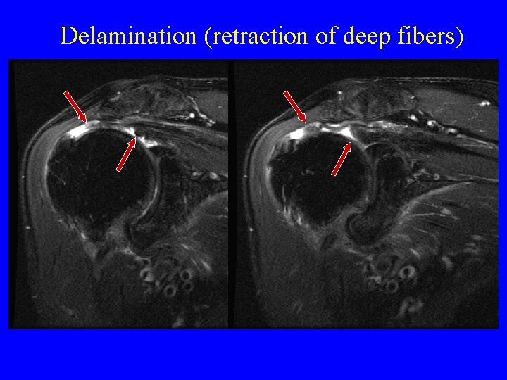 Delamination (retraction of deep fibers) 