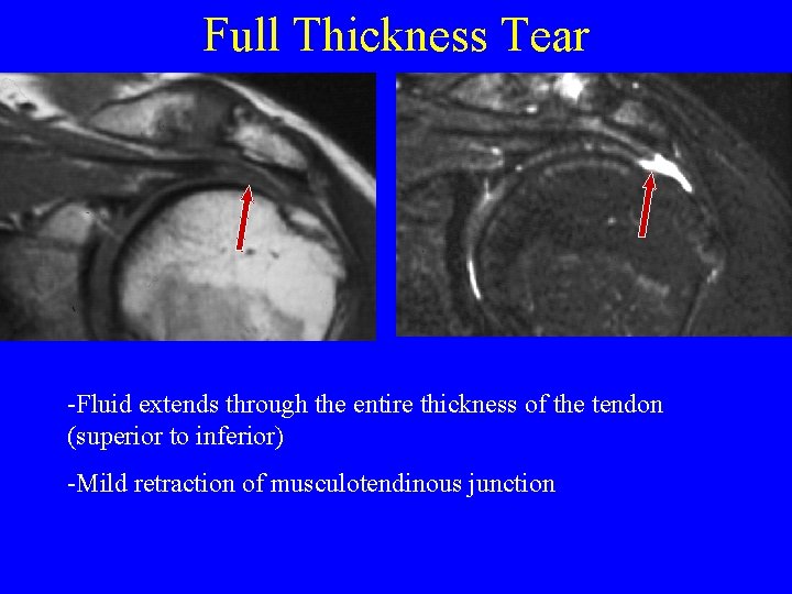 Full Thickness Tear -Fluid extends through the entire thickness of the tendon (superior to