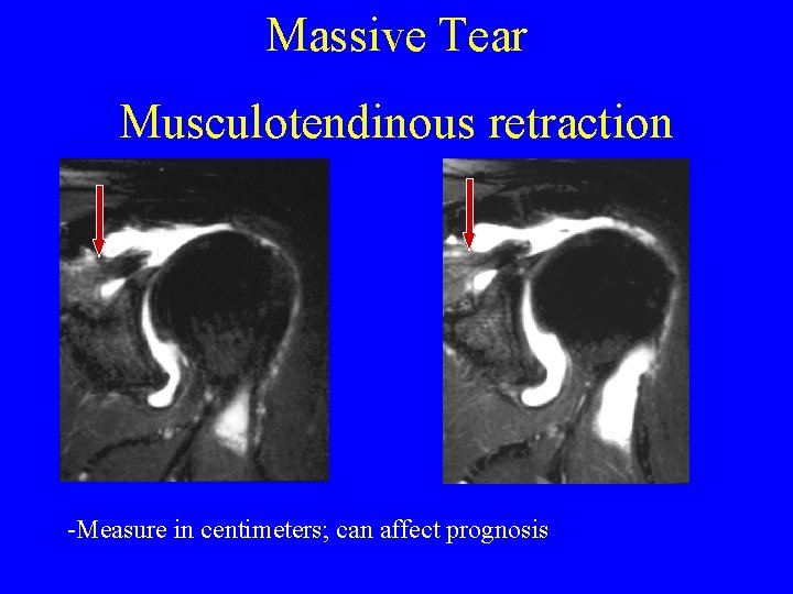 Massive Tear Musculotendinous retraction -Measure in centimeters; can affect prognosis 