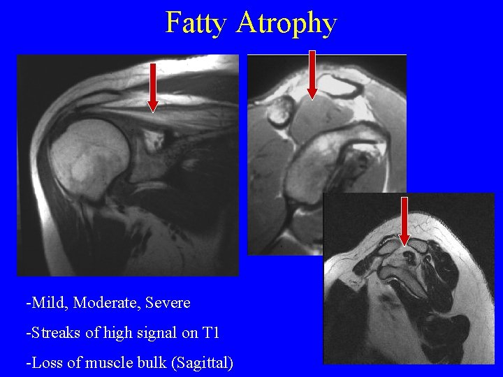 Fatty Atrophy -Mild, Moderate, Severe -Streaks of high signal on T 1 -Loss of