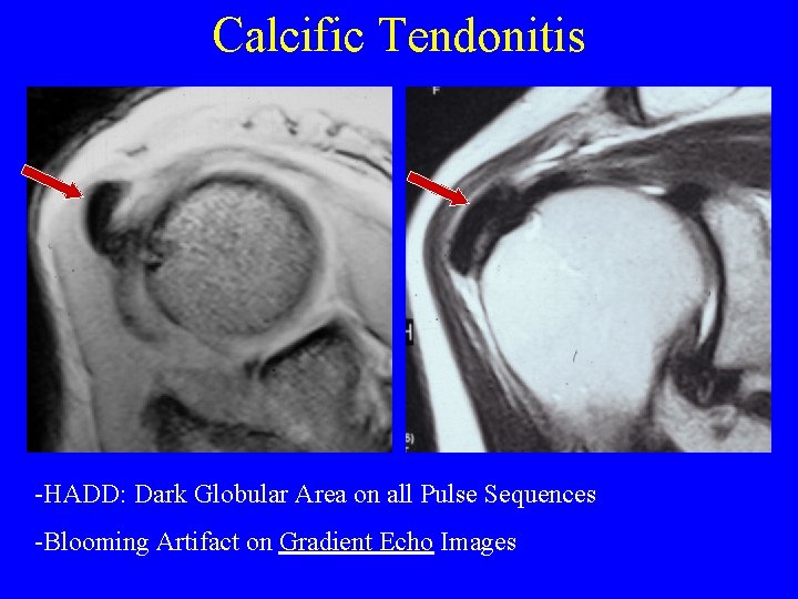 Calcific Tendonitis -HADD: Dark Globular Area on all Pulse Sequences -Blooming Artifact on Gradient