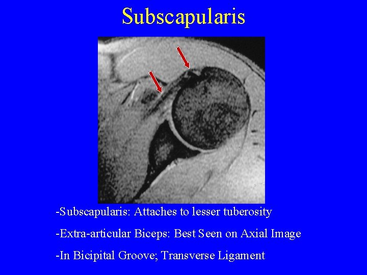 Subscapularis -Subscapularis: Attaches to lesser tuberosity -Extra-articular Biceps: Best Seen on Axial Image -In