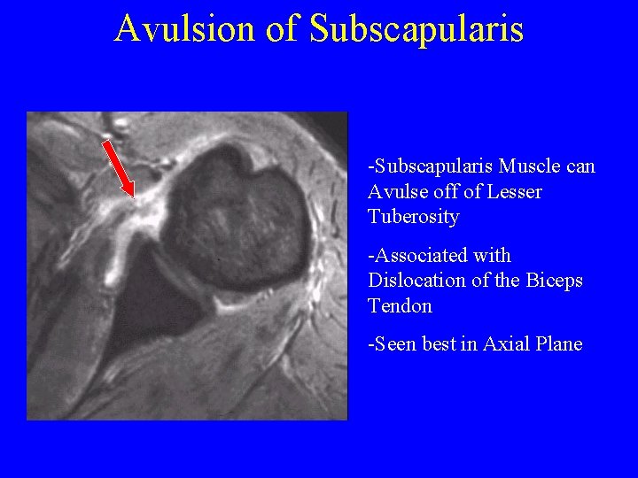 Avulsion of Subscapularis -Subscapularis Muscle can Avulse off of Lesser Tuberosity -Associated with Dislocation