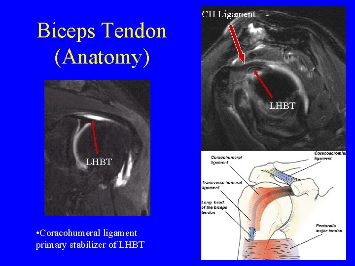 Biceps Tendon (Anatomy) CH Ligament LHBT • Coracohumeral ligament primary stabilizer of LHBT 