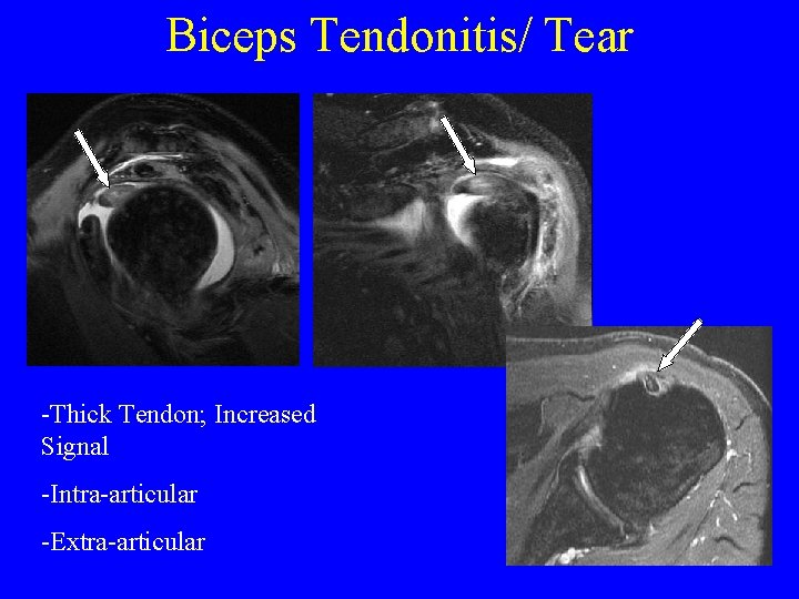 Biceps Tendonitis/ Tear -Thick Tendon; Increased Signal -Intra-articular -Extra-articular 